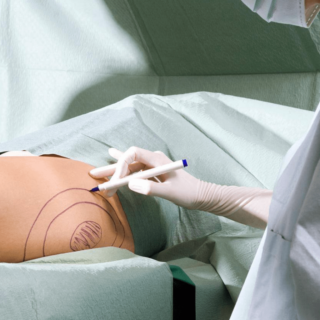 implantimplant ile popo büyütme-başar kaya klinik ankara